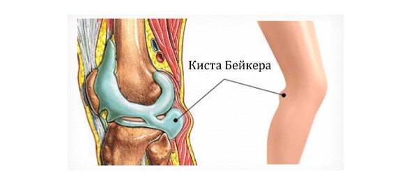 Киста бейкера коленного как лечить. Воспалился подколенный лимфоузел. Киста Бейкера в икроножной мышце.